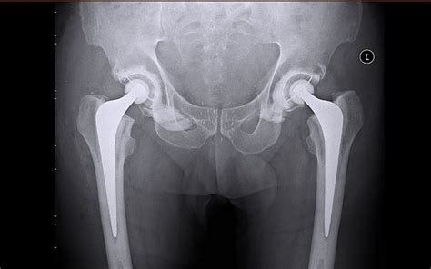 fai sex|Better sex after hip arthroscopy; Sexual dysfunction in patients .